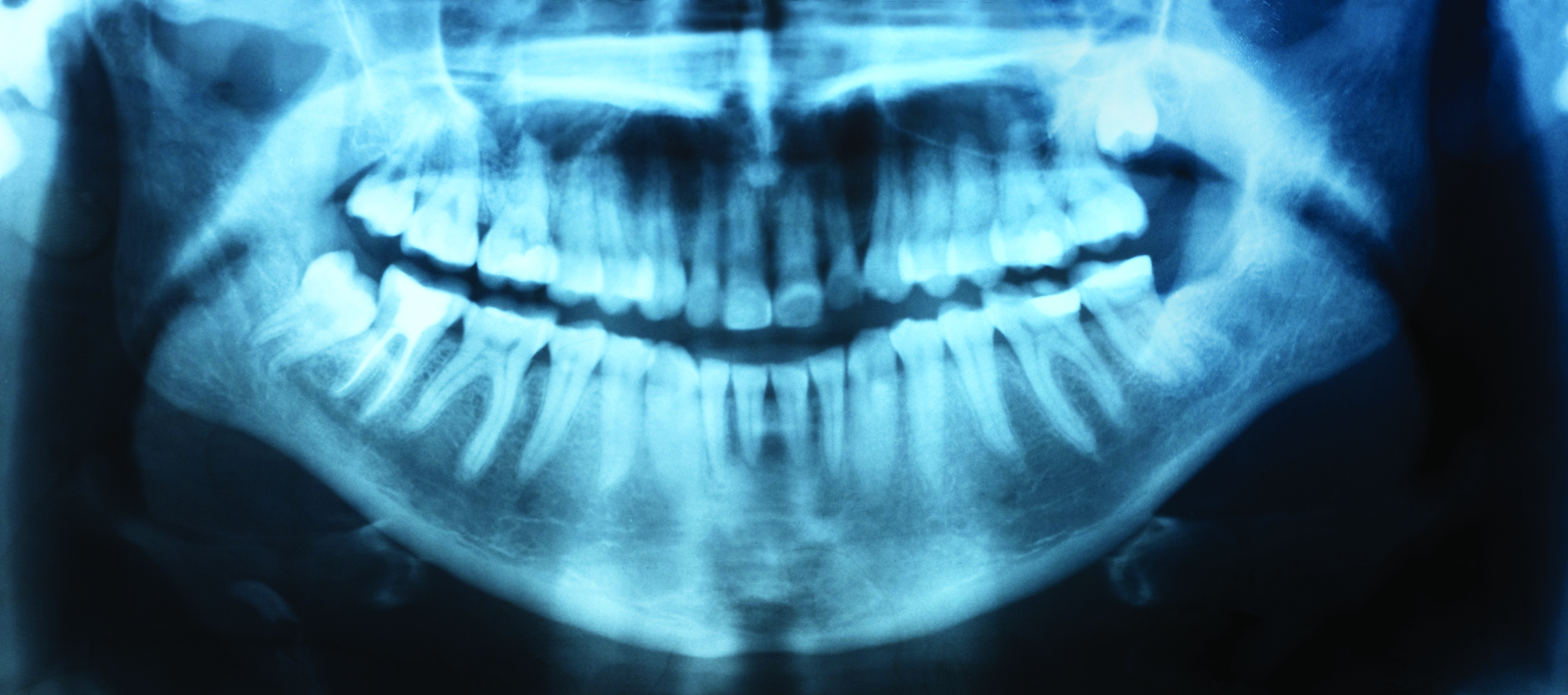 Dental-X-rays